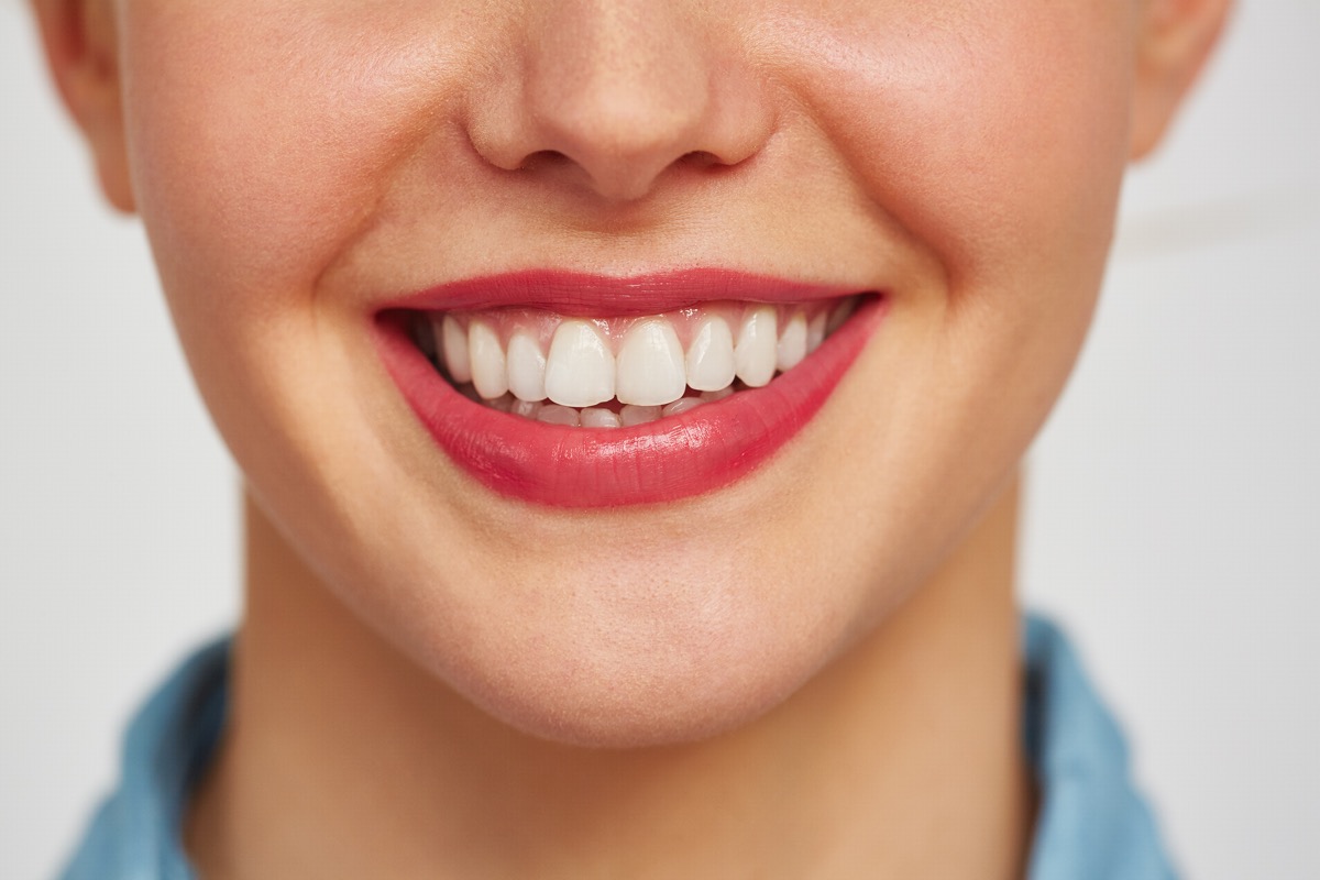 Kompozit Bonding Nedir? Hakkında Bilgiler